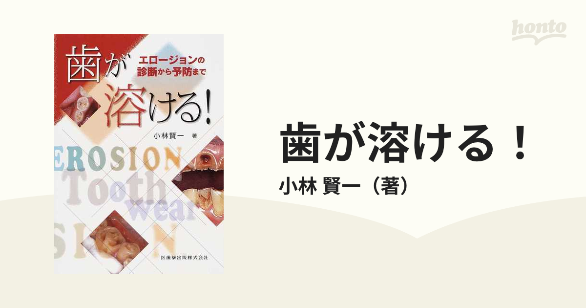 歯が溶ける！ エロージョンの診断から予防までの通販/小林 賢一 - 紙の