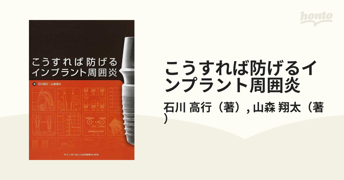 こうすれば防げるインプラント周囲炎の通販/石川 高行/山森 翔太 - 紙