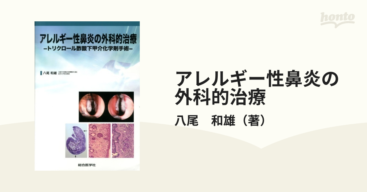 アレルギー性鼻炎の外科的治療－トリクロール酢酸下甲介化学剤手術 [