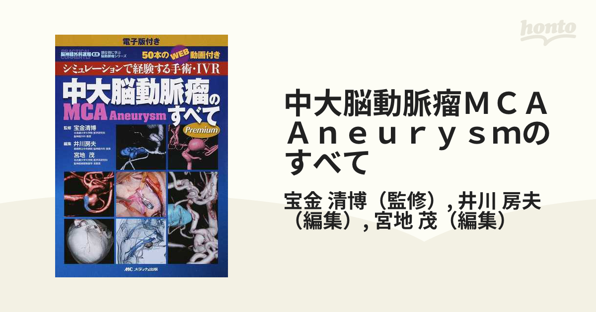 中大脳動脈瘤ＭＣＡ Ａｎｅｕｒｙｓｍのすべて シミュレーションで経験