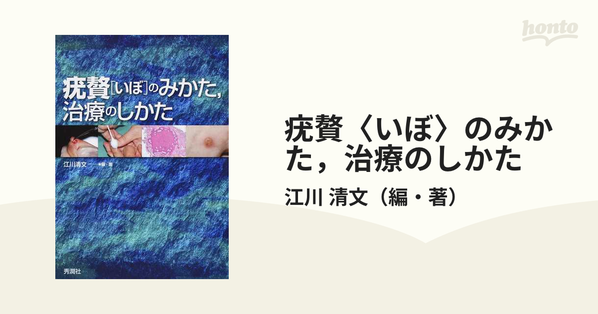 疣贅(いぼ)のみかた，治療のしかた [単行本] 清文， 江川 | www