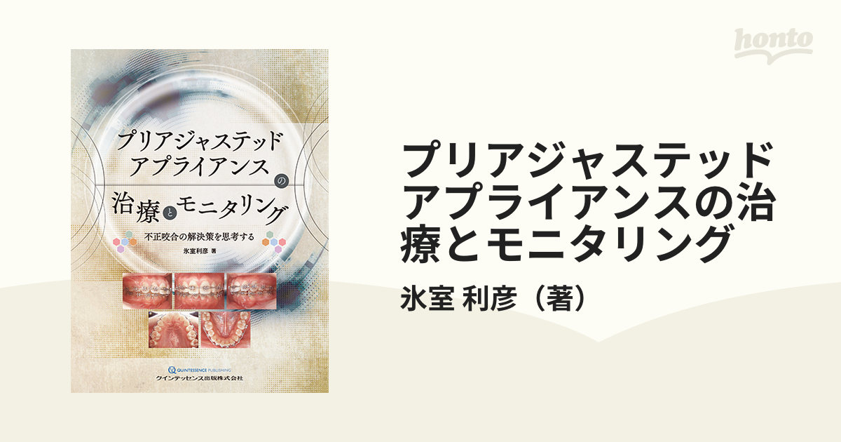 プリアジャステッドアプライアンスの治療とモニタリング 不正咬合の