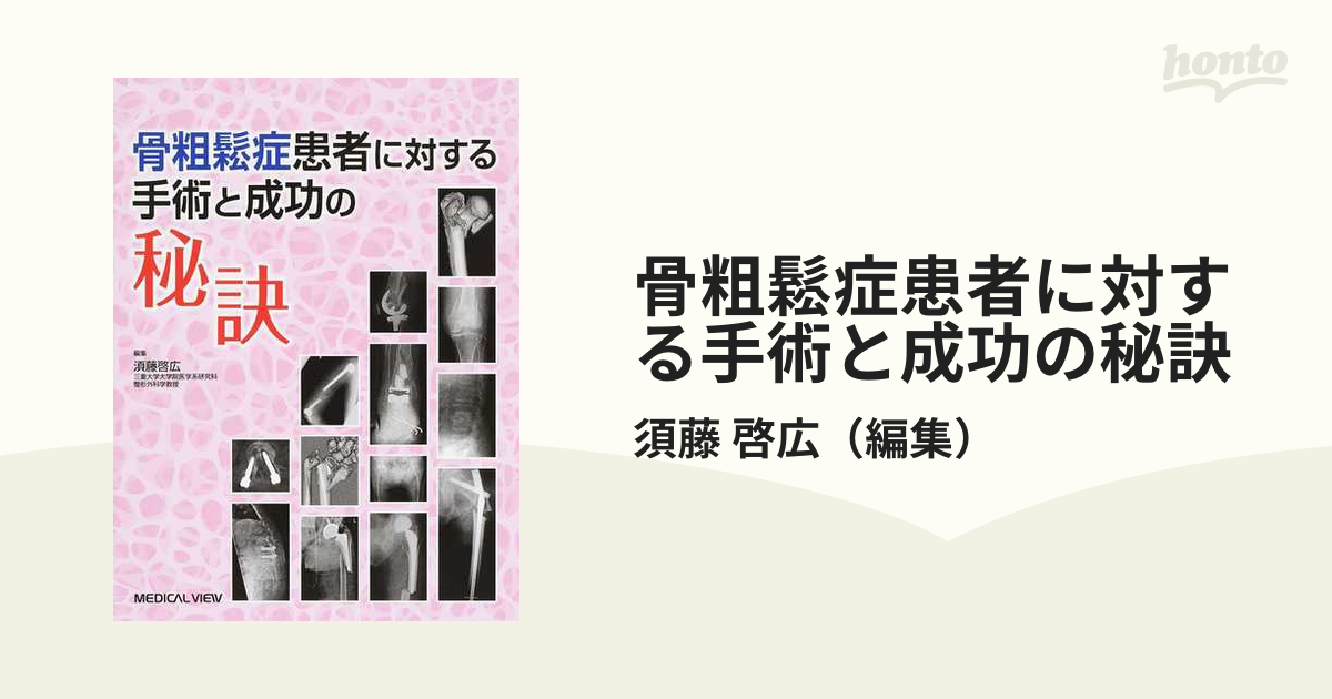 骨粗鬆症患者に対する手術と成功の秘訣