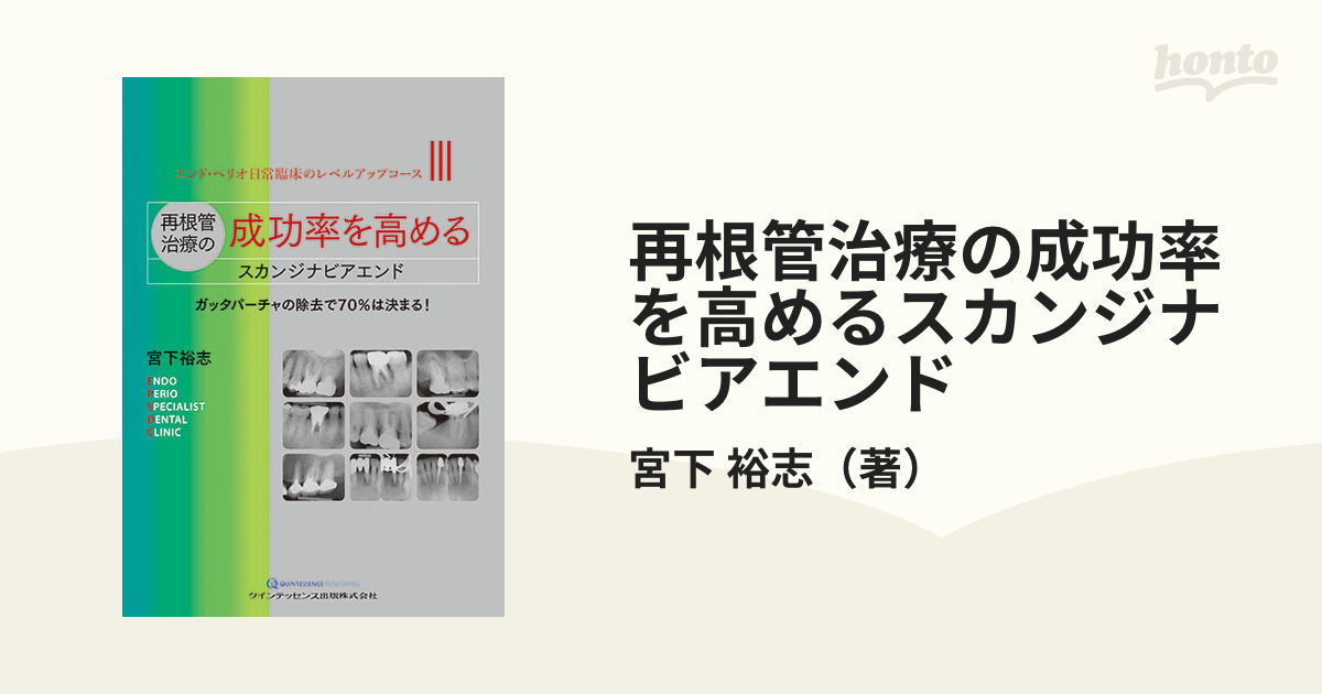 再根管治療の成功率を高めるスカンジナビアエンド ガッタパーチャの除去で７０％は決まる！