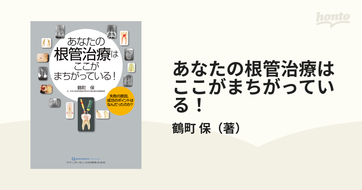 あなたの根管治療はここがまちがっている 失敗の原因,成功のポイントは