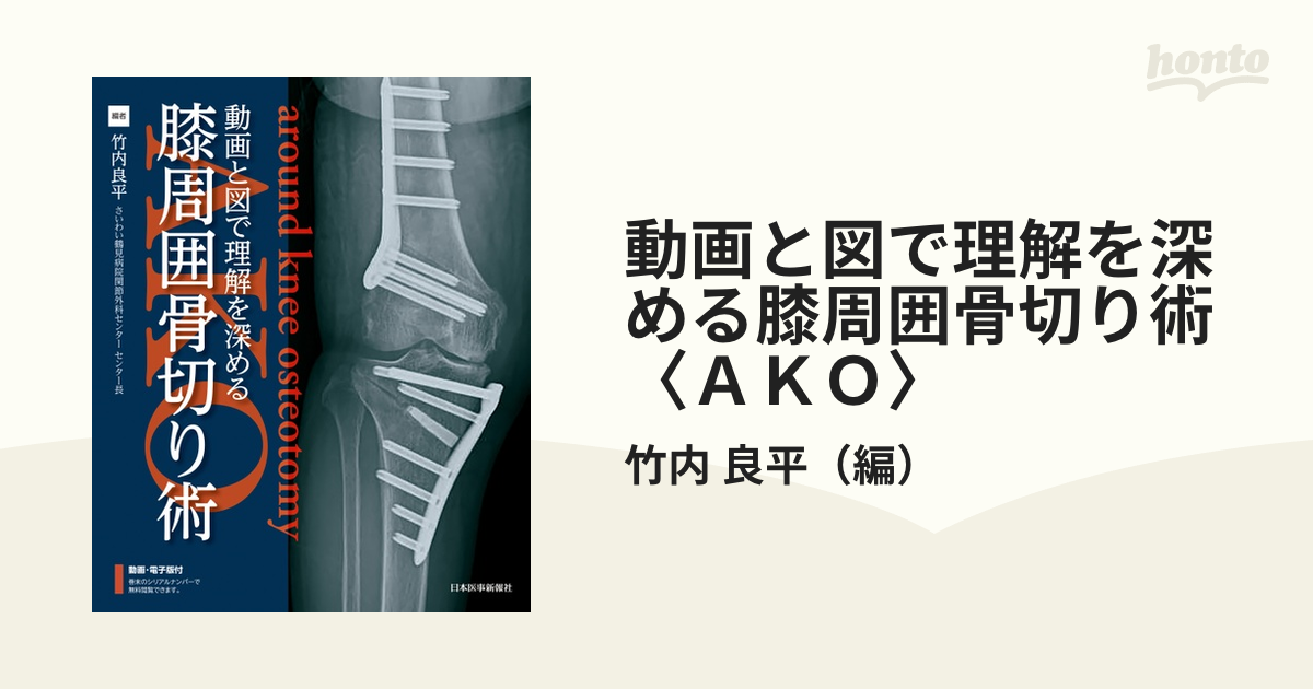 良平　動画と図で理解を深める膝周囲骨切り術〈ＡＫＯ〉の通販/竹内　紙の本：honto本の通販ストア